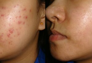 Eu vou remover manchas e espinhas no photoshop