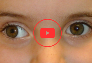 Eu vou fazer um video para você, tenho estrabismo